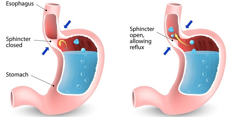 How To Cure Acid Reflux Naturally